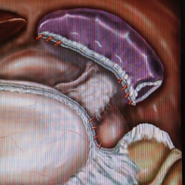 Esplenectomía