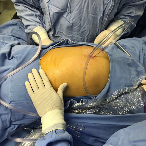 Colecistectomía endoscópica de mínima invasión.
“Cirugía Sin Huella”